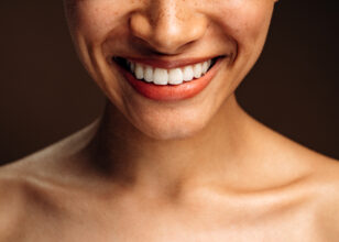 Come migliorare l’estetica dentale