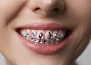 Tooth gems: cosa sono e come si applicano