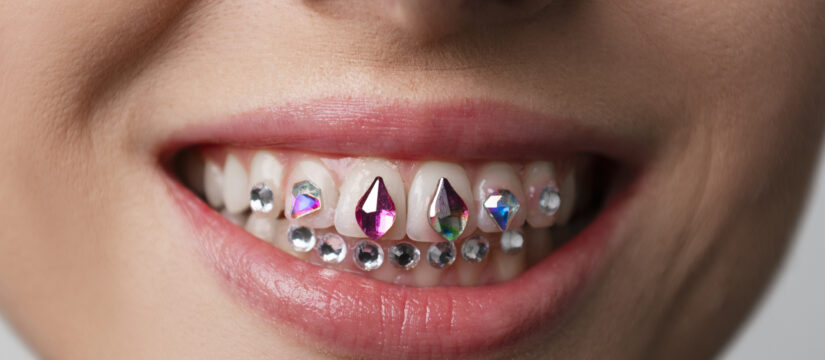 Tooth gems: cosa sono e come si applicano